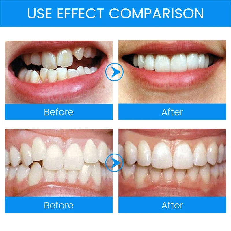 3 Stages Dental Orthodontic Teeth Retainer | Anti-Snoring & Teeth Straightening Mouth Guard