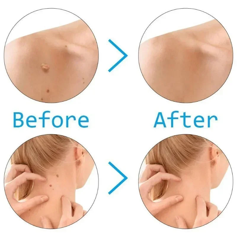 Skin Tag Remover Kit | Skin Care Rubber Bands for Face Mole and Wart Removal