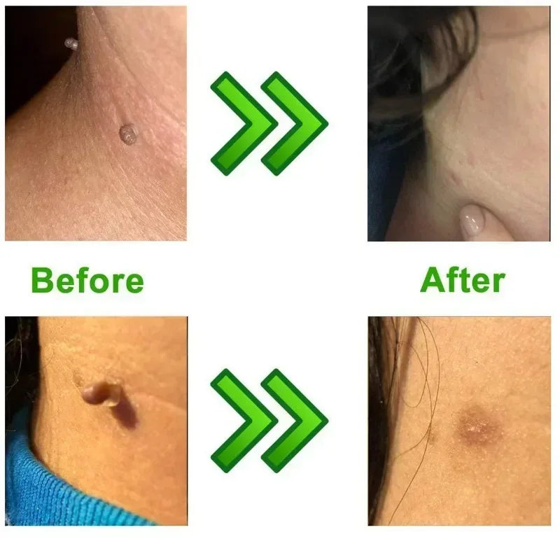 Skin Tag Remover Kit | Skin Care Rubber Bands for Face Mole and Wart Removal