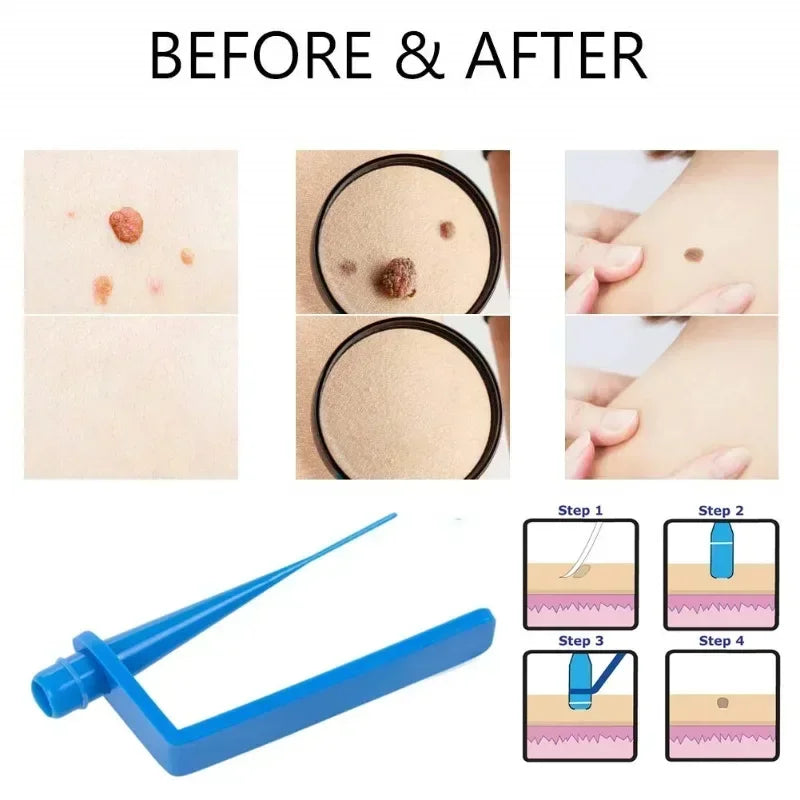 Skin Tag Remover Kit | Skin Care Rubber Bands for Face Mole and Wart Removal